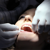 前歯が黄ばんでいる人はホワイトニングをやるべき？
